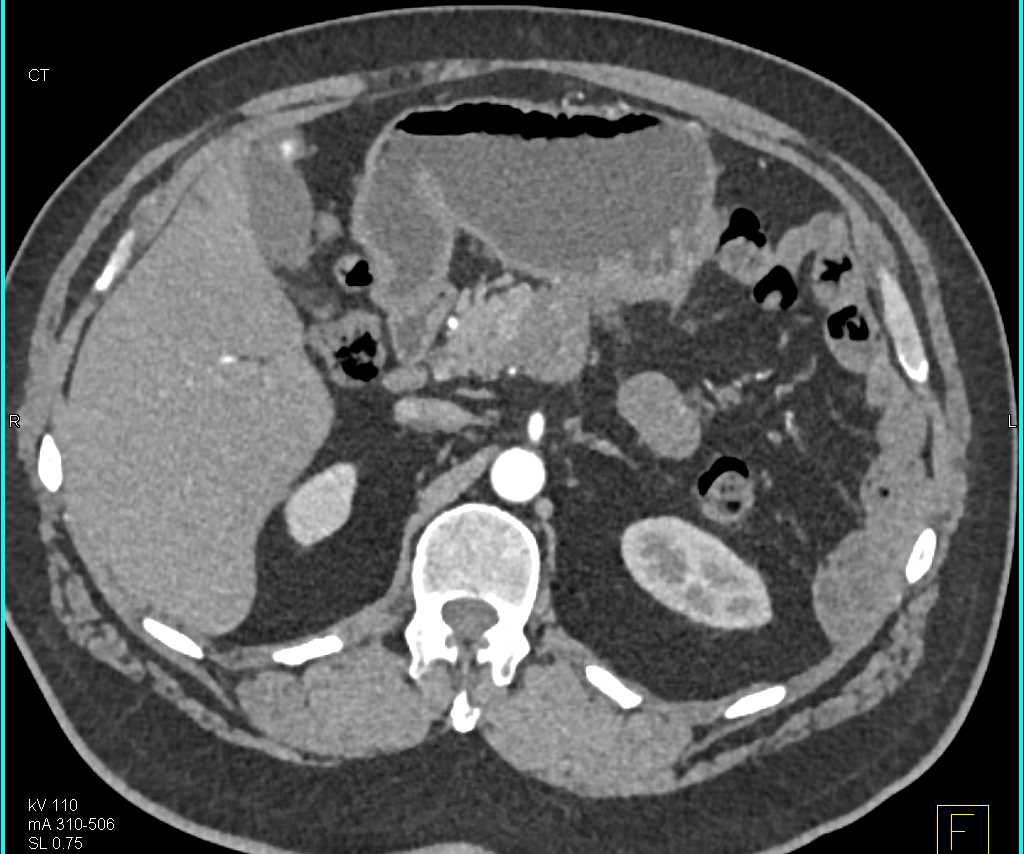 MCN (Mucinous Cystic Neoplasm) Body of Pancreas - CTisus CT Scan