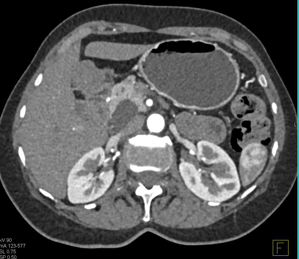 Intraductal Papillary Mucinous Neoplasm (IPMN) - CTisus CT Scan