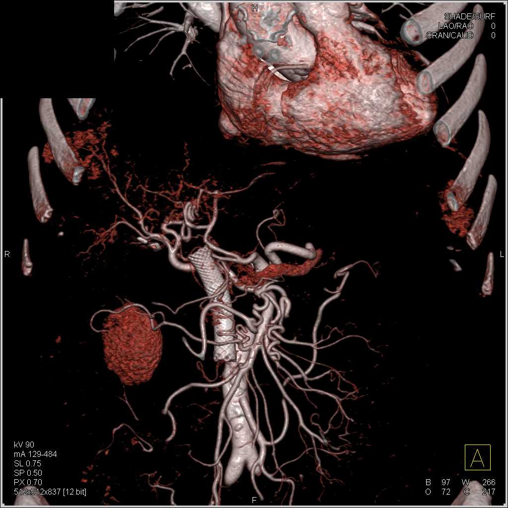 Stent in Common Bile Duct (CBD) in Patient with Pancreatic Cancer - CTisus CT Scan