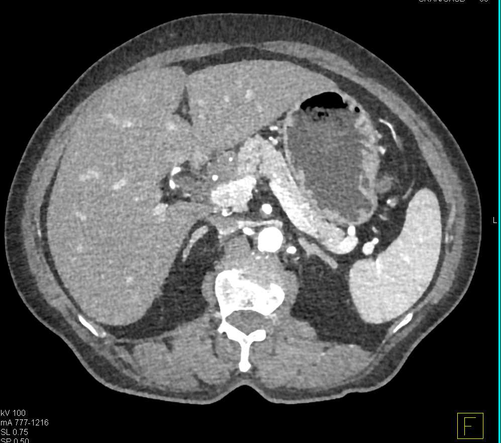 Chronic Pancreatitis - CTisus CT Scan