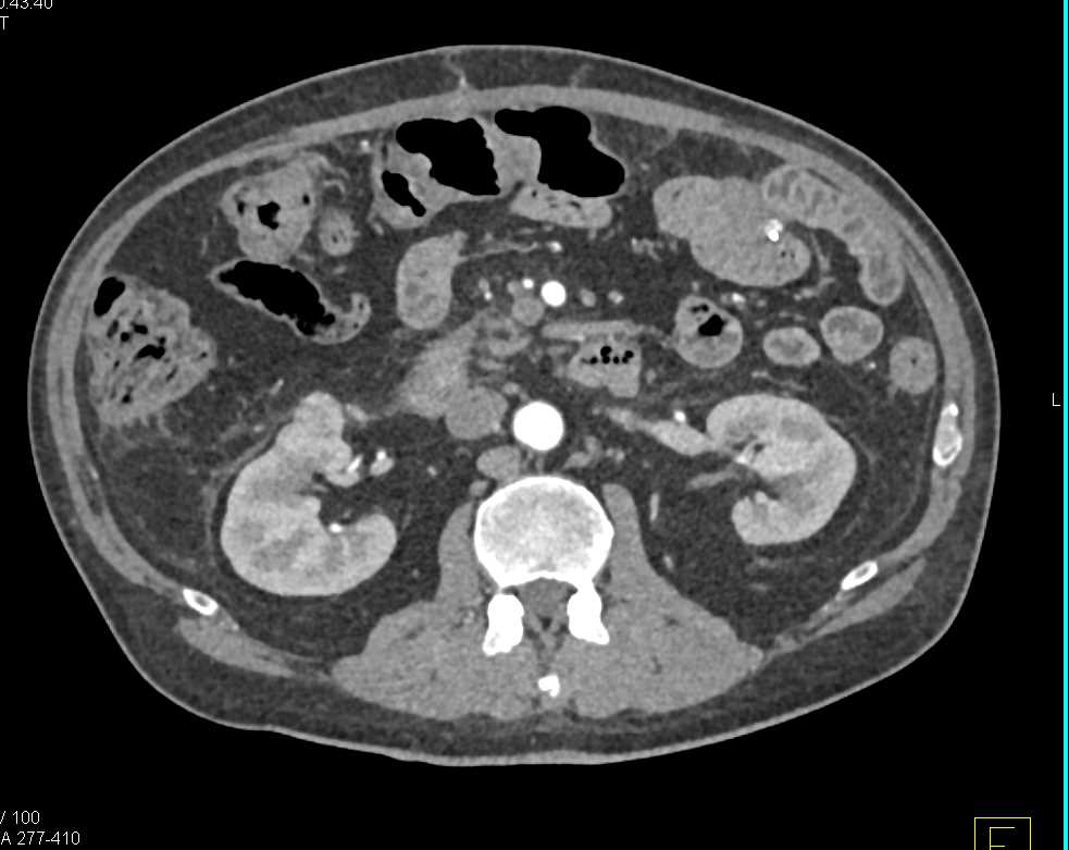 Pancreatic Cancer with Vascular Involvement - CTisus CT Scan