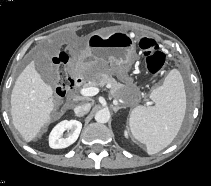 Adenocarcinoma Tail of Pancreas with Carcinomatosis - CTisus CT Scan