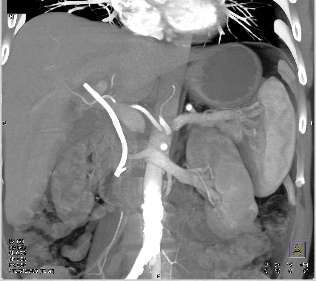 Carcinoma Pancreas with Stent in Common Bile Duct (CBD) - CTisus CT Scan