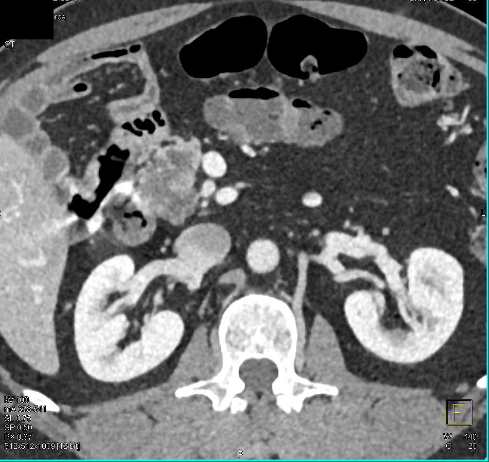 Pancreatic Adenocarcinoma Arising in an Intraductal Papillary Mucinous Neoplasm (IPMN) - CTisus CT Scan