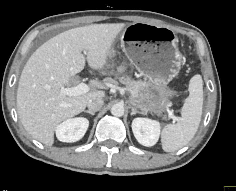 Pancreas Adenocarcinoma - CTisus CT Scan