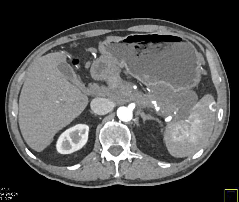 Neuroendocrine Tumor of the Pancreas with Calcifications - CTisus CT Scan