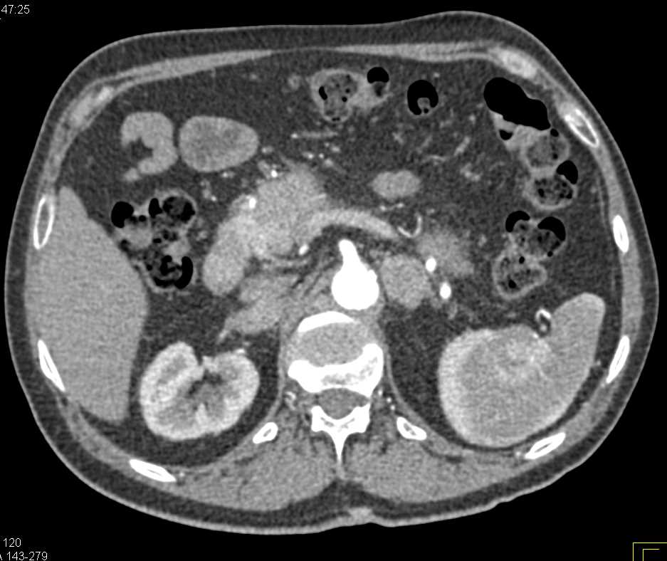 Autoimmune Pancreatitis - CTisus CT Scan