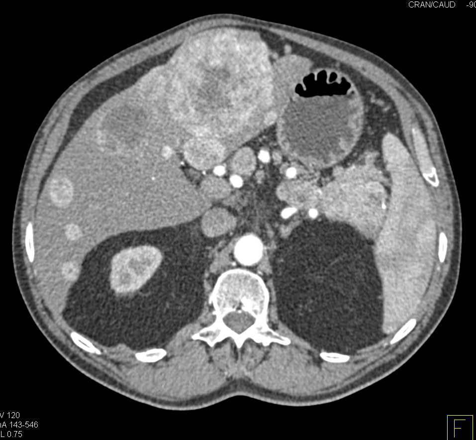 Neuroendocrine Tumor in the Tail of the Pancreas with Liver Metastases - CTisus CT Scan