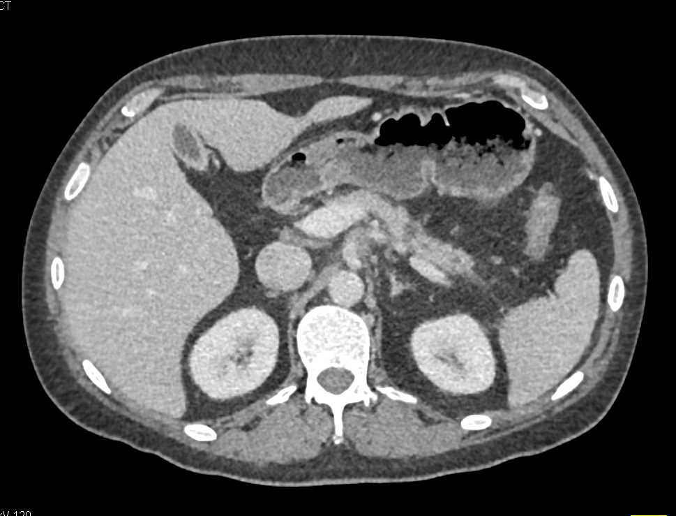 Subtle Pancreatic Cancer - CTisus CT Scan