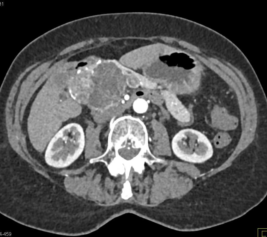 Serous Cystadenoma Head of Pancreas - CTisus CT Scan