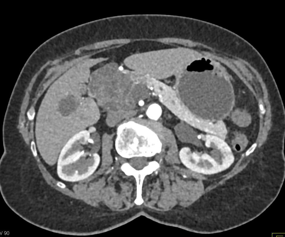 Serous Cystadenoma Head of Pancreas - CTisus CT Scan