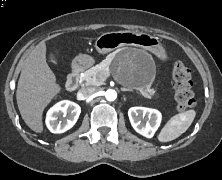 MCN (Mucinous Cystic Neoplasm) with Septations in the Tail of the Pancreas - CTisus CT Scan