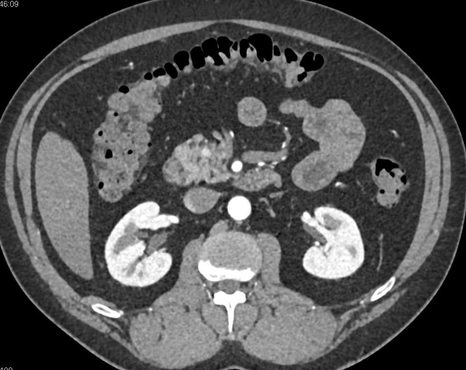 1cm Pancreatic Neuroendocrine Tumor (PNET) in the Head of the Pancreas - CTisus CT Scan