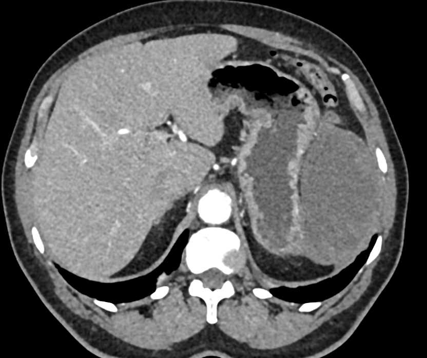 Omental Infarction Left Upper Quadrant Following Splenectomy and Distal Pancreatectomy - CTisus CT Scan