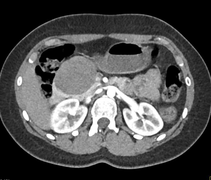 Solid and Papillary Epithelial Neoplasm (SPEN) Tumor in the Head of the Pancreas - CTisus CT Scan