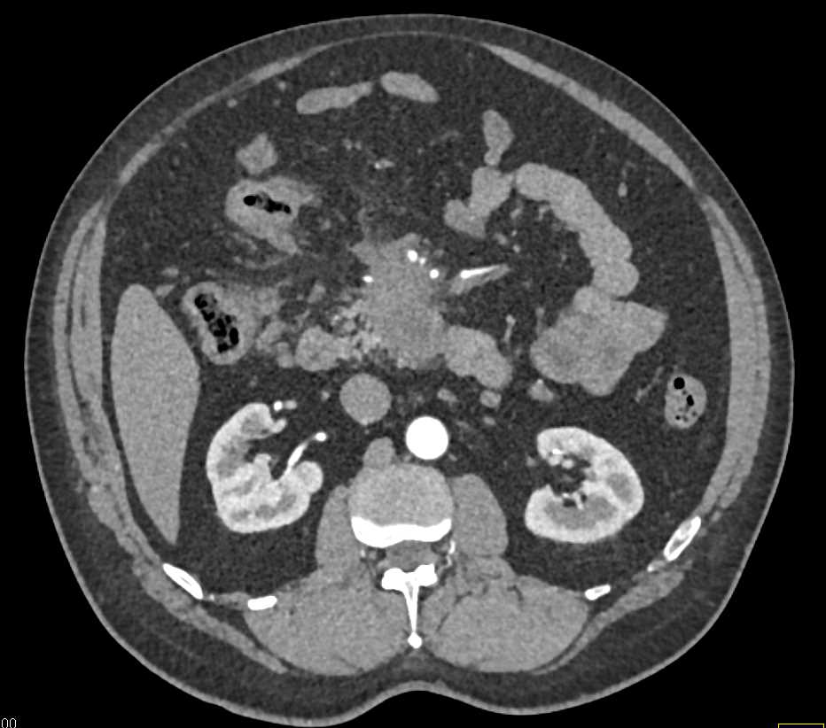 Pancreatic Adenocarcinoma Encases the Superior Mesenteric Artery (SMA) and Superior Mesenteric Vein (SMV) - CTisus CT Scan