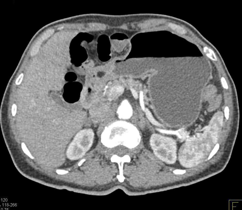 Lipoma in Body of Pancreas - CTisus CT Scan