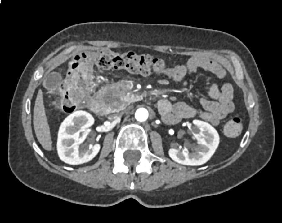 Invasive Adenocarcinoma Head of the Pancreas with Local Spread - CTisus CT Scan