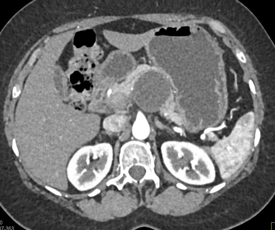 MCN (Mucinous Cystic Neoplasm) Body of Pancreas - CTisus CT Scan