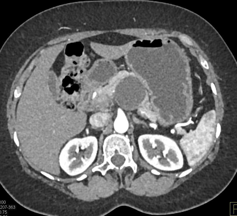 MCN (Mucinous Cystic Neoplasm) Body of Pancreas - CTisus CT Scan