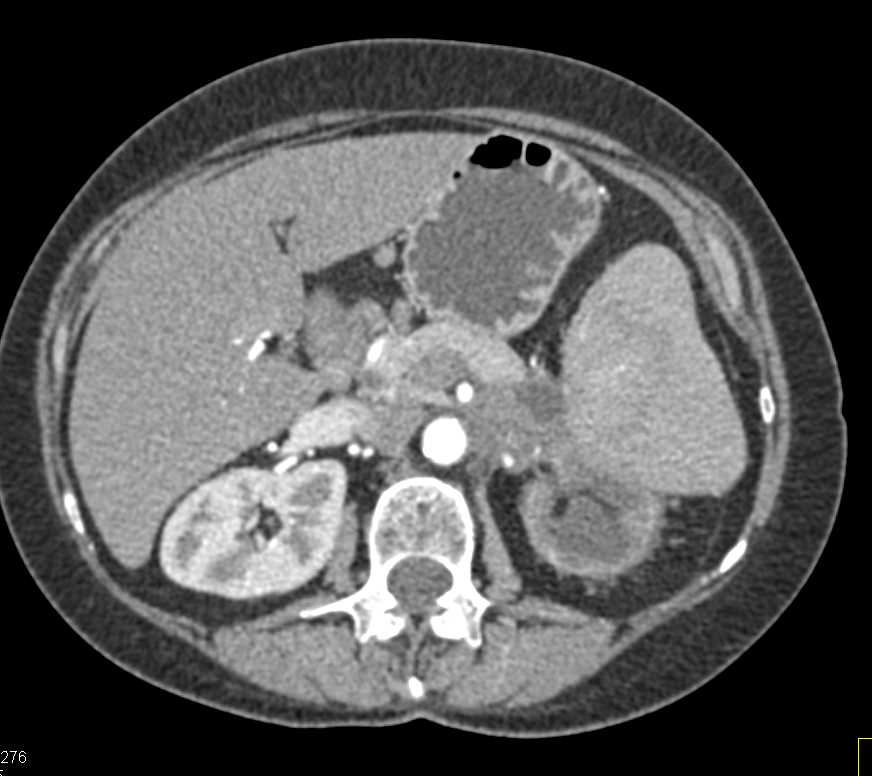 Pancreas Cancer Invades the Duodenum and the Left Kidney - CTisus CT Scan