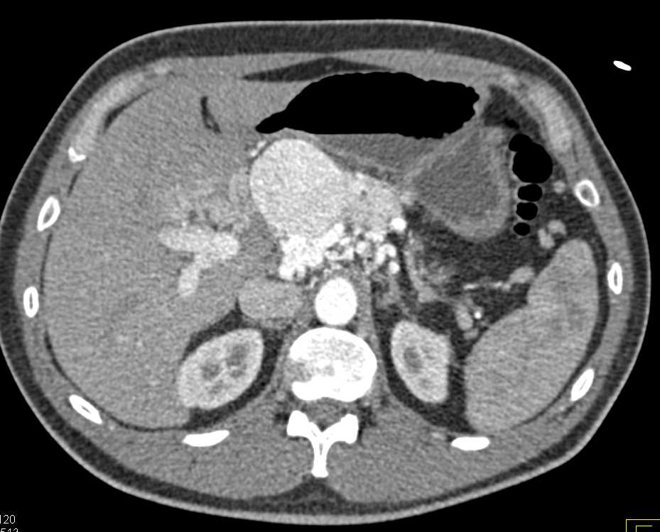 Pancreatic Neuroendocrine Tumor (PNET) Pancreas with PV Thrombosis - CTisus CT Scan