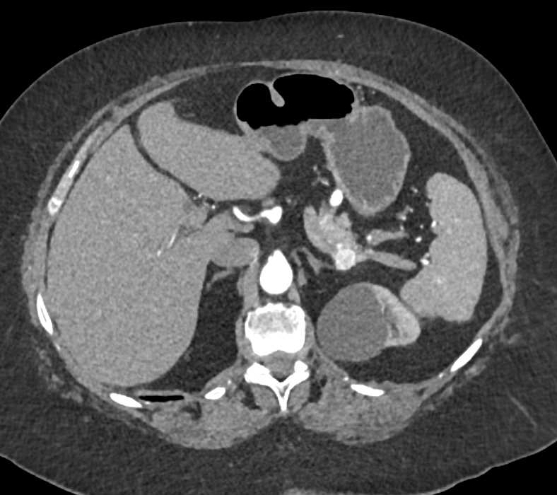 Renal Cell Carcinoma with Partial Nephrectomy with Pancreas Metastases - CTisus CT Scan