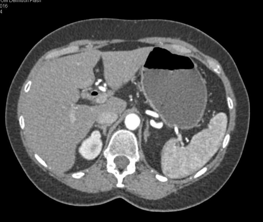 Carcinoma of the Pancreas - CTisus CT Scan