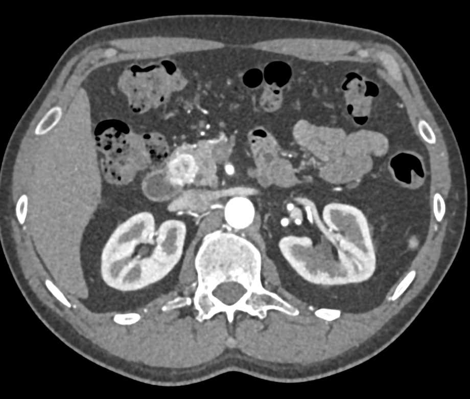 Neuroendocrine Tumor in the Head of the Pancreas - CTisus CT Scan