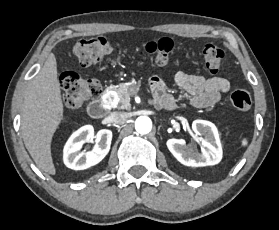 Neuroendocrine Tumor in the Head of the Pancreas - CTisus CT Scan