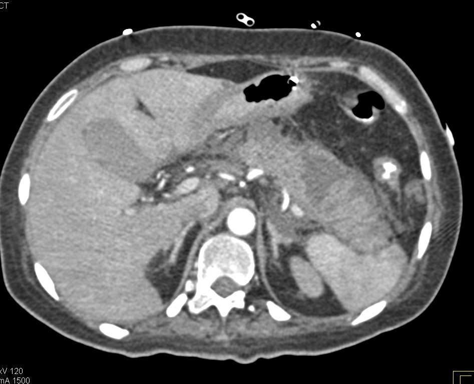 Acute Pancreatitis with Inflammation and Hemorrhage - CTisus CT Scan