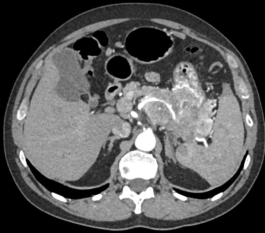 Neuroendocrine Tumor Tail of Pancreas with Vascular Invasion - CTisus CT Scan