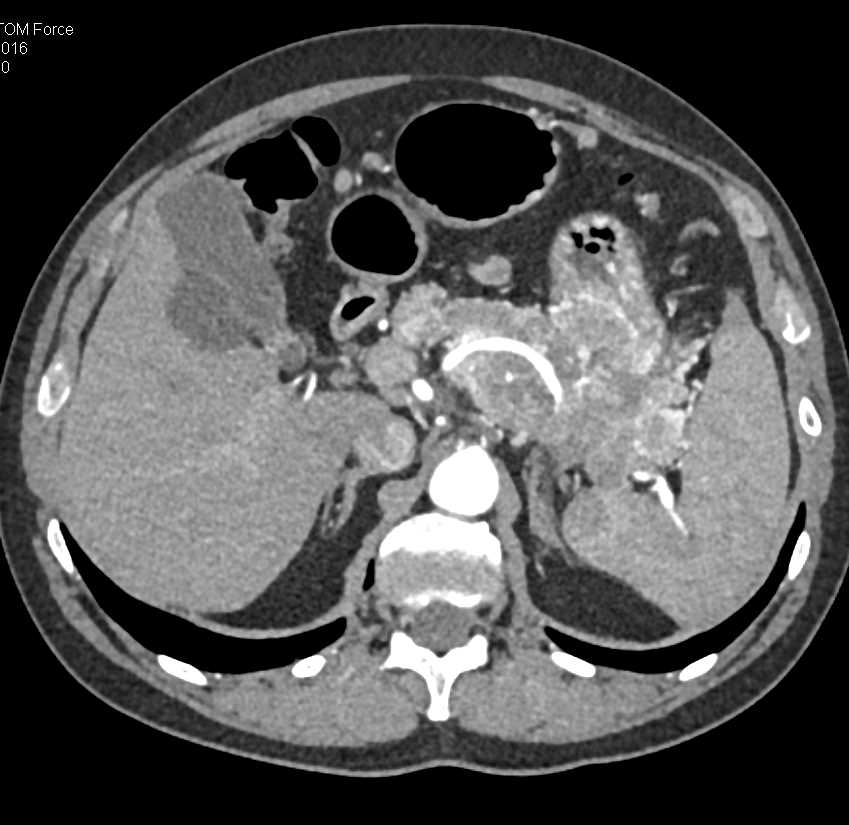 Neuroendocrine Tumor Tail of Pancreas with Vascular Invasion - CTisus CT Scan