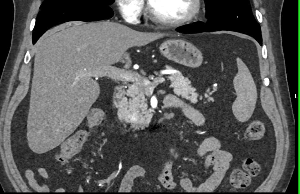 Incidental Pancreatic Neuroendocrine Tumor (PNET) Head of Pancreas - CTisus CT Scan