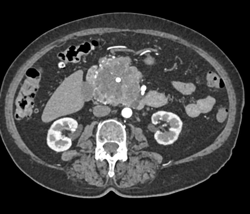 Serous Cystadenoma Pancreas - CTisus CT Scan