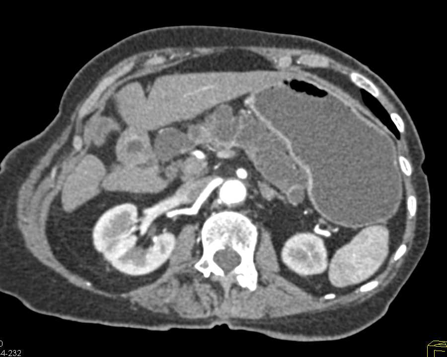 Mixed Type Intraductal Papillary Mucinous Neoplasm (IPMN) with Moderate Grade Dysplasia - CTisus CT Scan