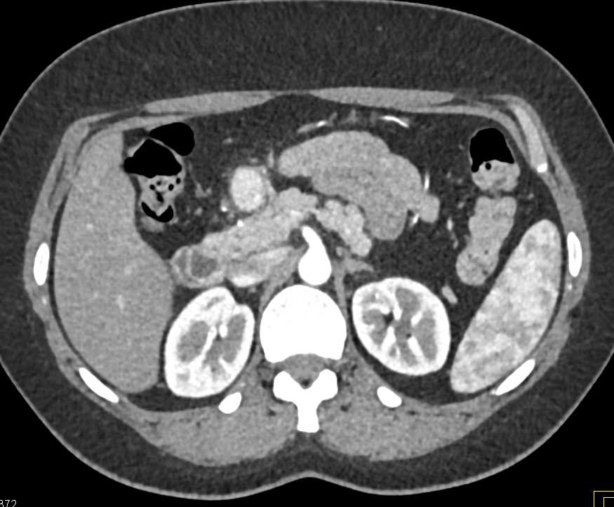 Neuroendocrine Tumor Near the Head of Pancreas - CTisus CT Scan