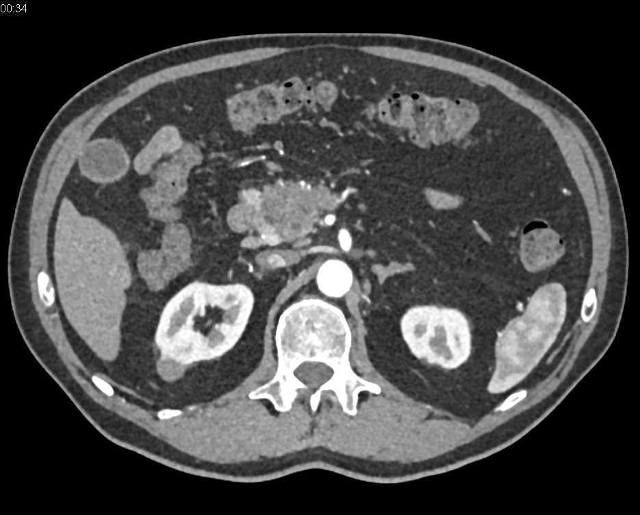 Adenocarcinoma of the Pancreas with a Double Duct Sign - CTisus CT Scan