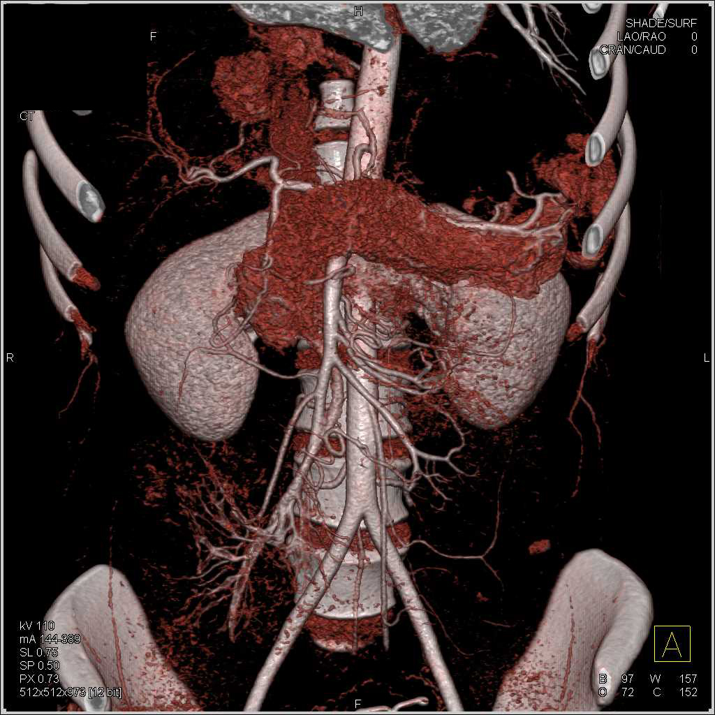 Normal Pancreas in 3D - CTisus CT Scan