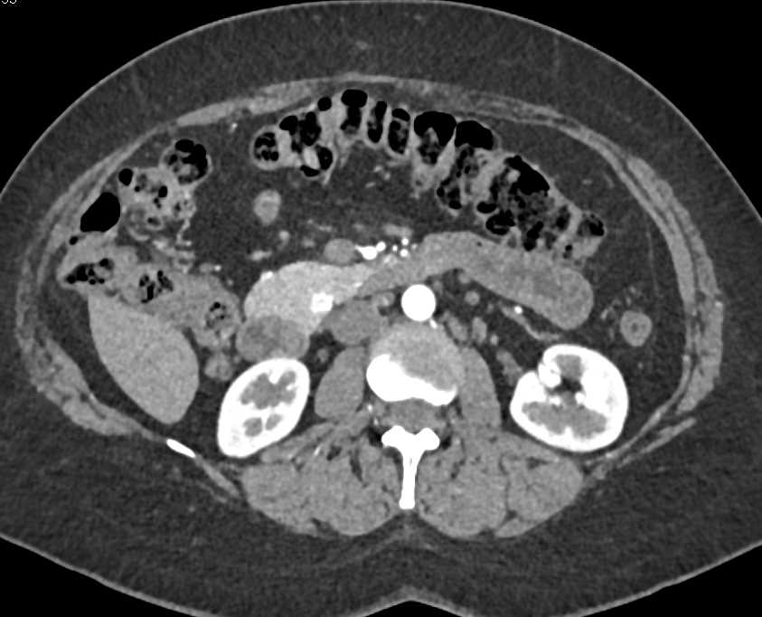 Vascular Pancreatic Neuroendocrine Tumor (PNET) in the Head of the Pancreas - CTisus CT Scan