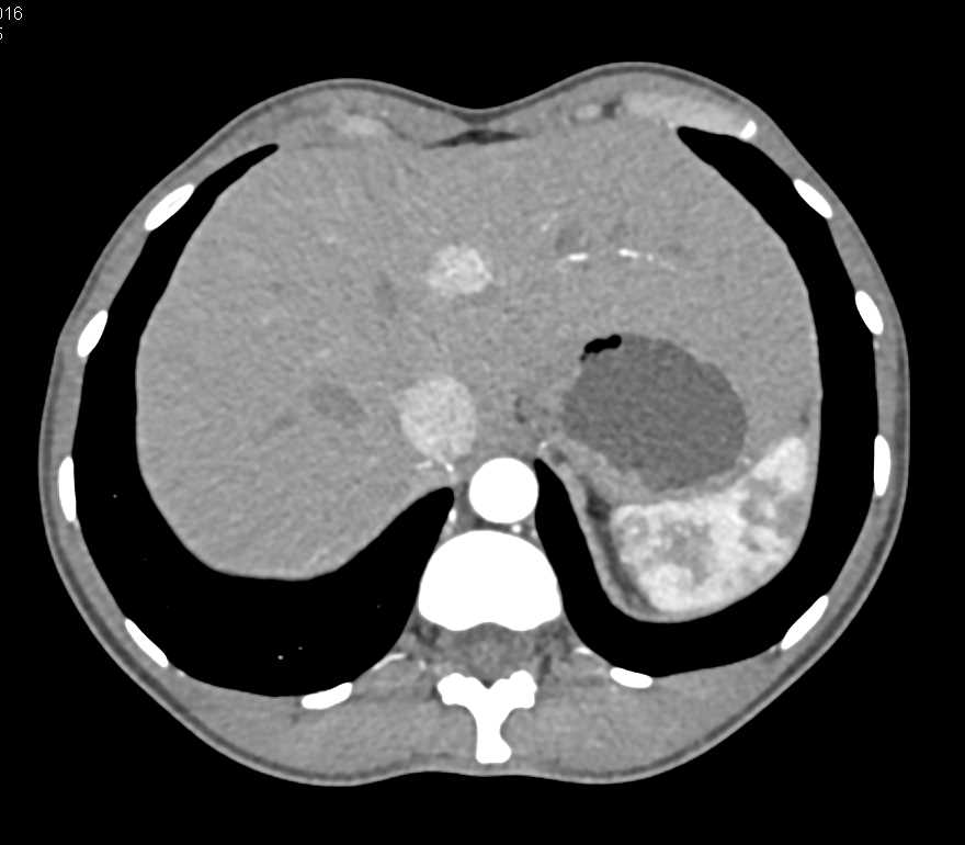 Annular Pancreas - CTisus CT Scan