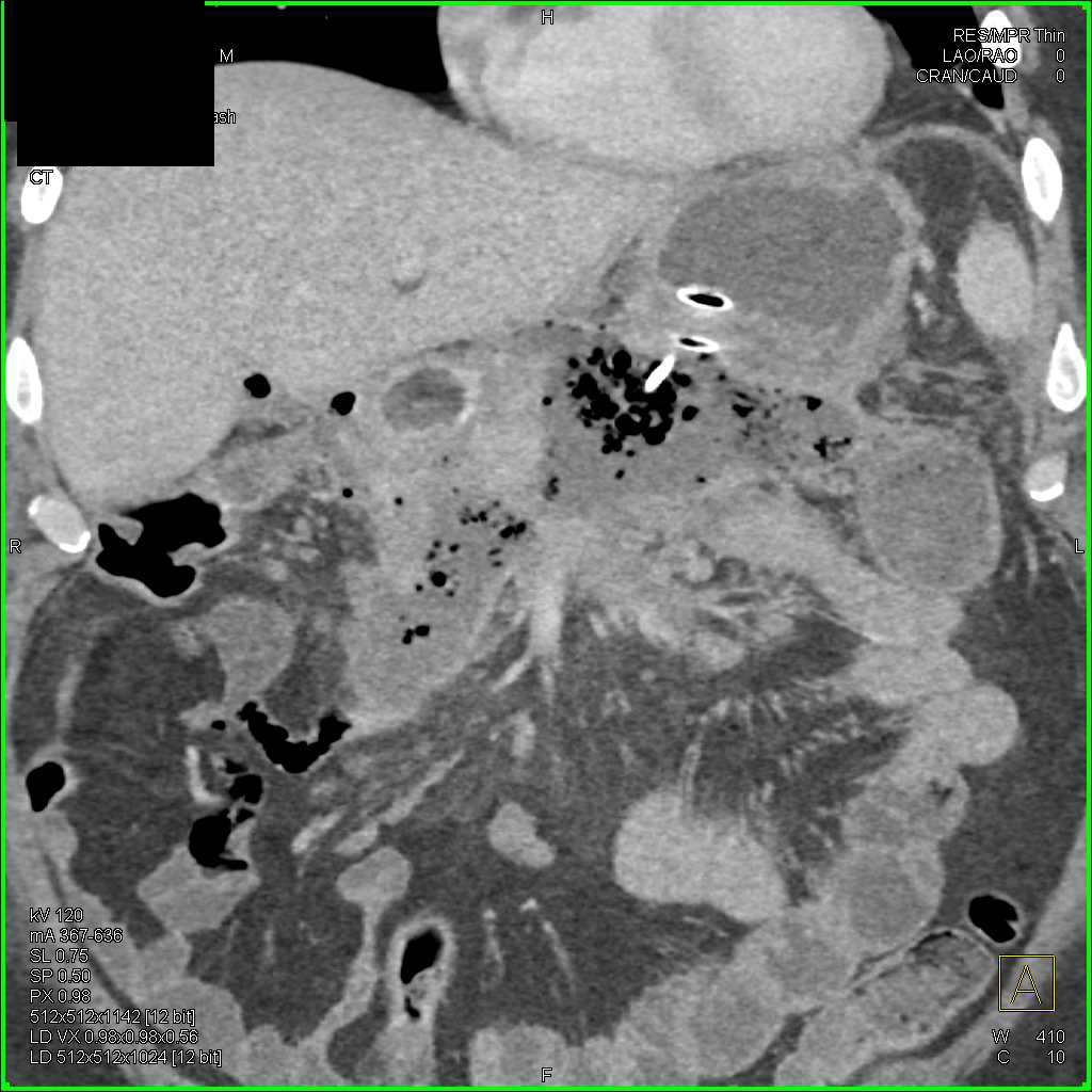 Pancreatic Necrosis and Abscess - CTisus CT Scan