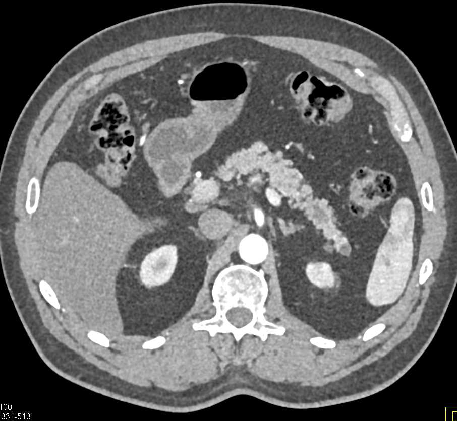 Lipoma Head of Pancreas and Intraductal Papillary Mucinous Neoplasms (IPMNs) - CTisus CT Scan