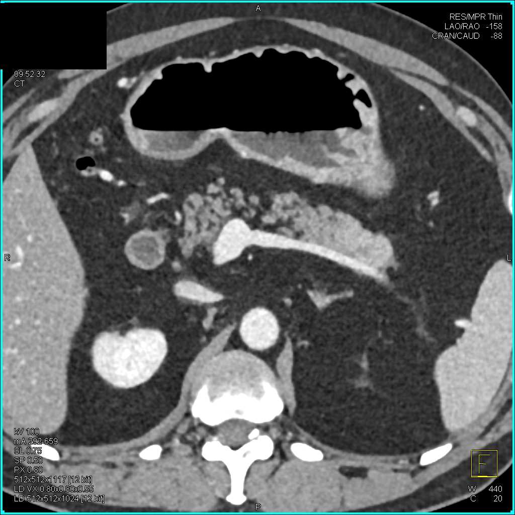 Autoimmune Pancreatitis - CTisus CT Scan