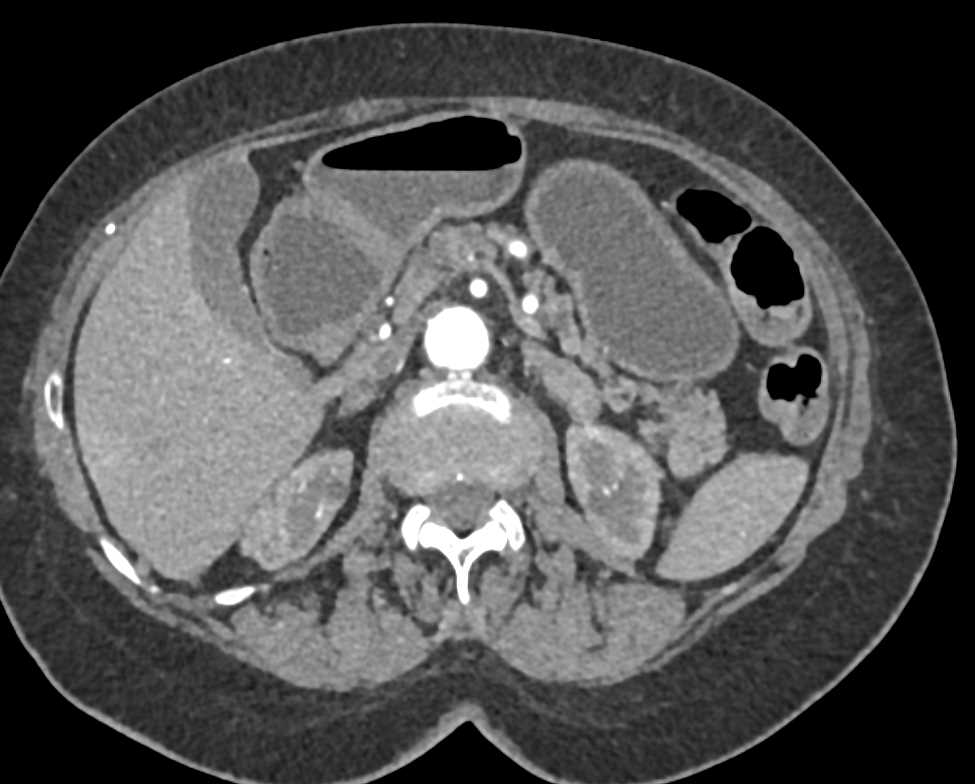 Multiple Intraductal Papillary Mucinous Neoplasms (IPMNs) - CTisus CT Scan