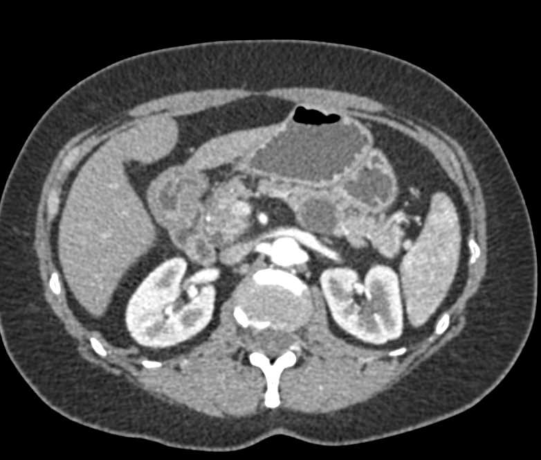 MCN (Mucinous Cystic Neoplasm) Body of the Pancreas - CTisus CT Scan