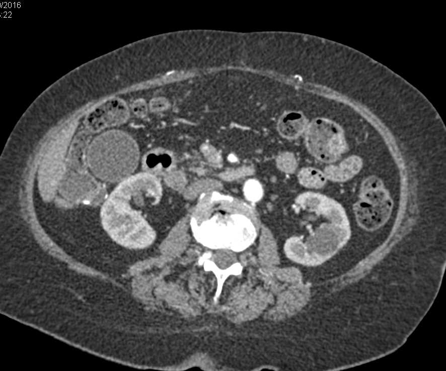 Ampullary Cancer with a Double Duct Sign - CTisus CT Scan