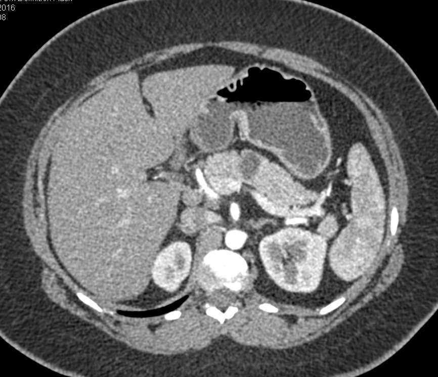 MCN (Mucinous Cystic Neoplasm) Body of the Pancreas - CTisus CT Scan