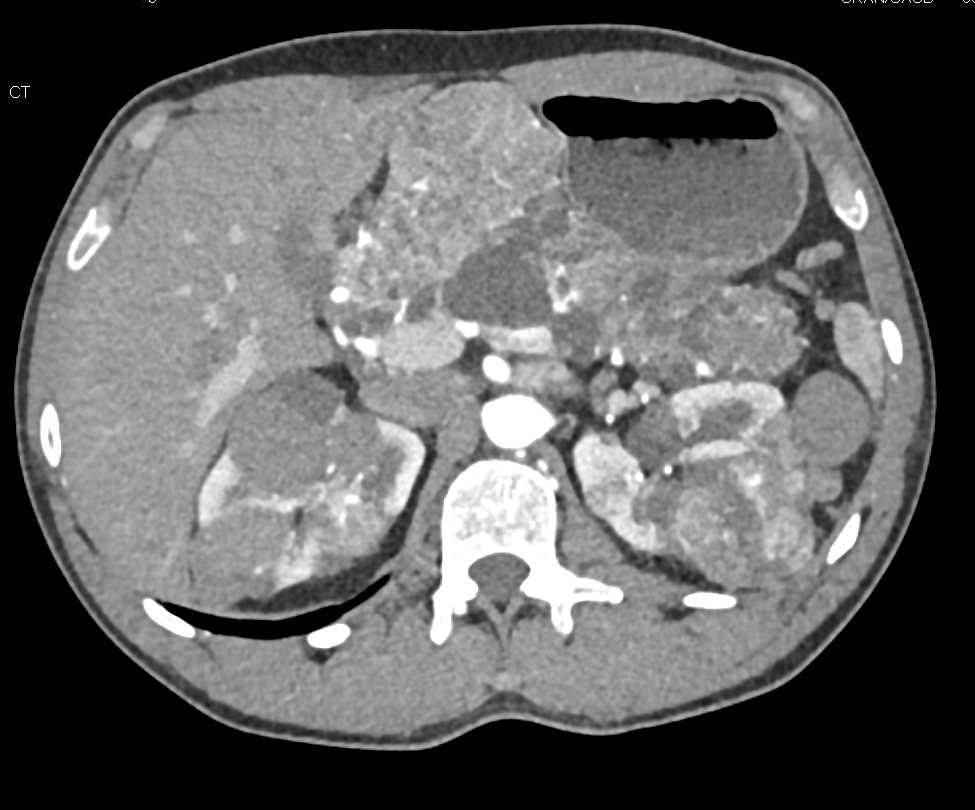 Von Hippel-Lindau Syndrome (VHL) with Multiple Renal Cell Carcinomas and Multiple Pancreatic Neuroendocrine Tumors (PNETs) - CTisus CT Scan