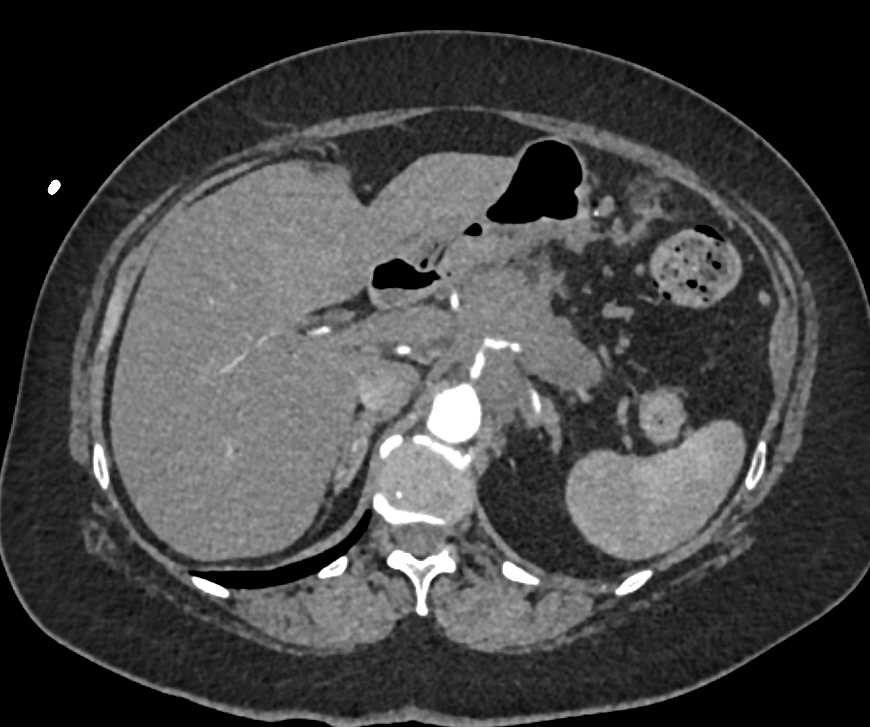 Pancreatic Cancer with Celiac and Superior Mesenteric Artery (SMA) Encasement - CTisus CT Scan